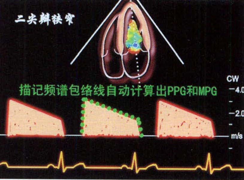 八、瓣膜狹窄程度